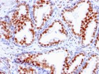 FFPE human prostate carcinoma sections stained with 100 ul anti-Androgen Receptor (clone SPM335) at 1:50. HIER epitope retrieval prior to staining was performed in 10mM Tris 1mM EDTA, pH 9.0.